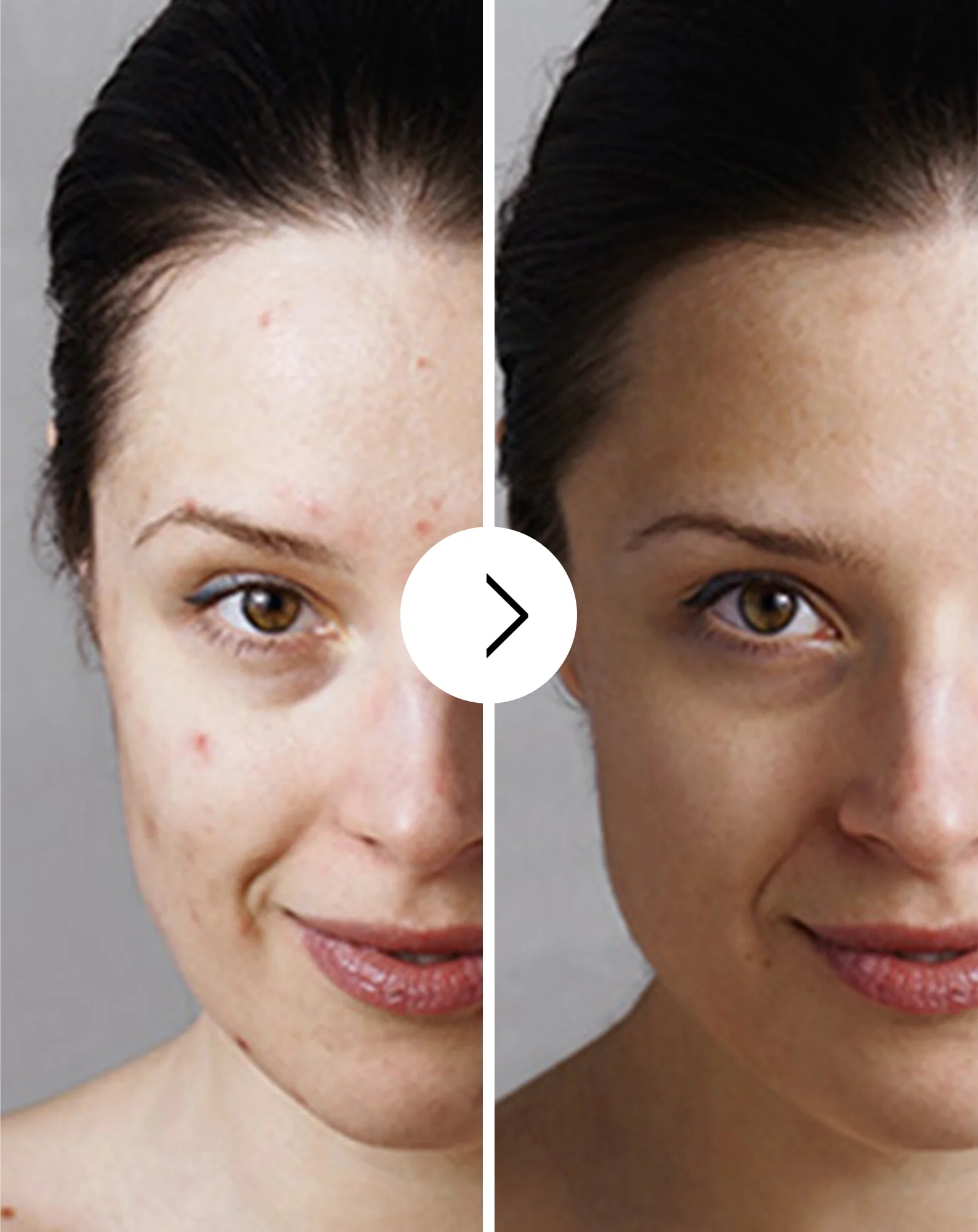 Comprimés pour l’acné, les boutons et les imperfections avec zinc, vitamine C, E et B2 Derminax - Image 3
