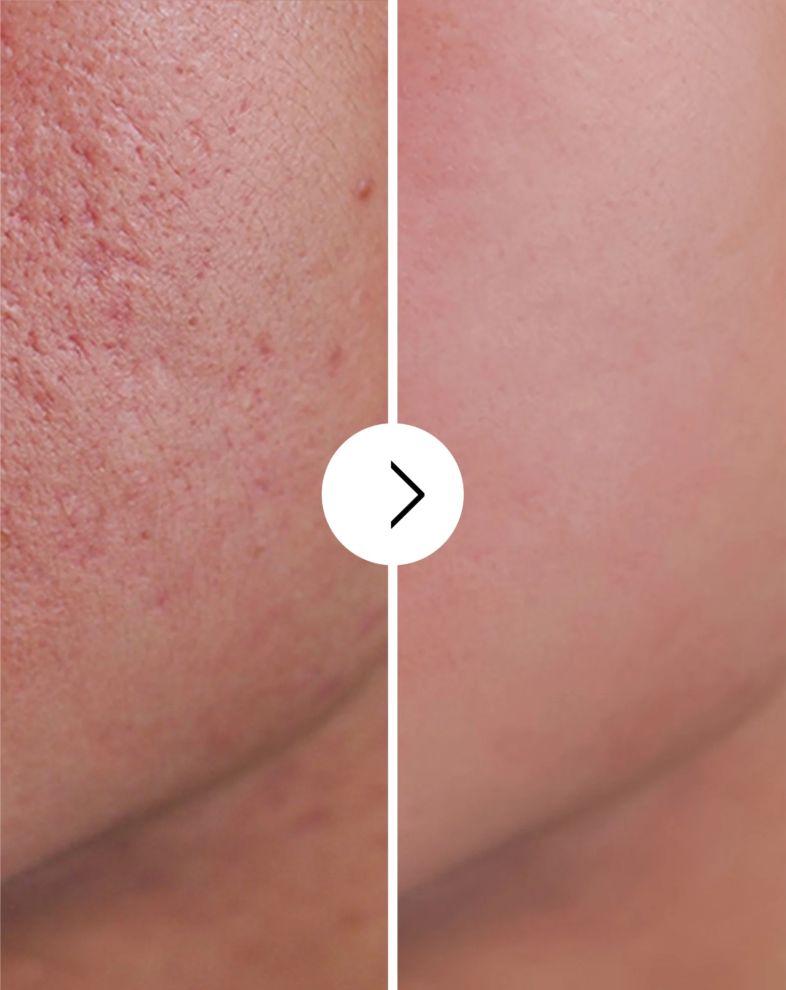 Comprimés pour l’acné, les boutons et les imperfections avec zinc, vitamine C, E et B2 Derminax - Image 4