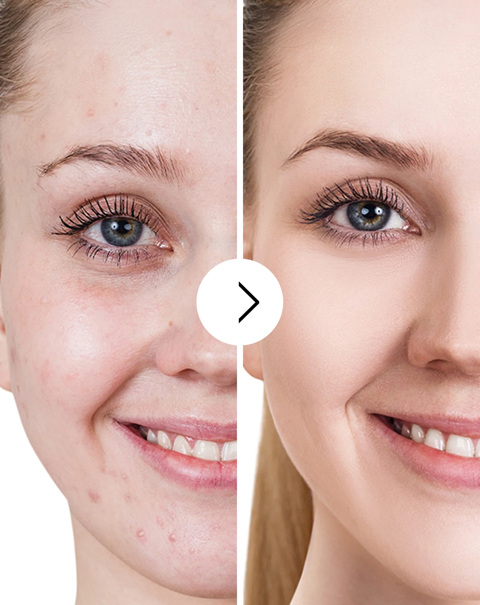 Comprimés pour l’acné, les boutons et les imperfections avec zinc, vitamine C, E et B2 Derminax - Image 5