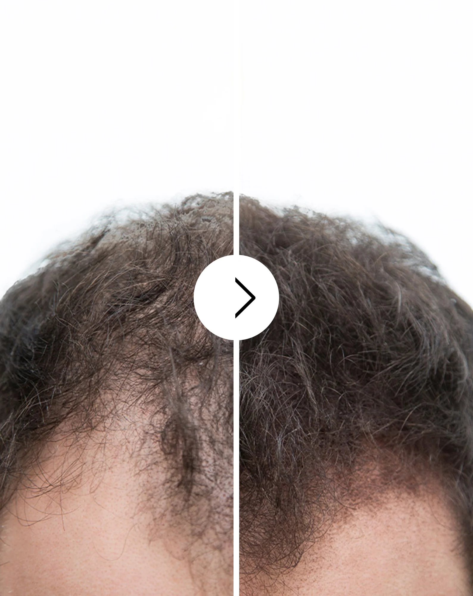 Gélules contre la chute des cheveux à effet épaississant et fortifiant Follixin 60 gélules - Image 2