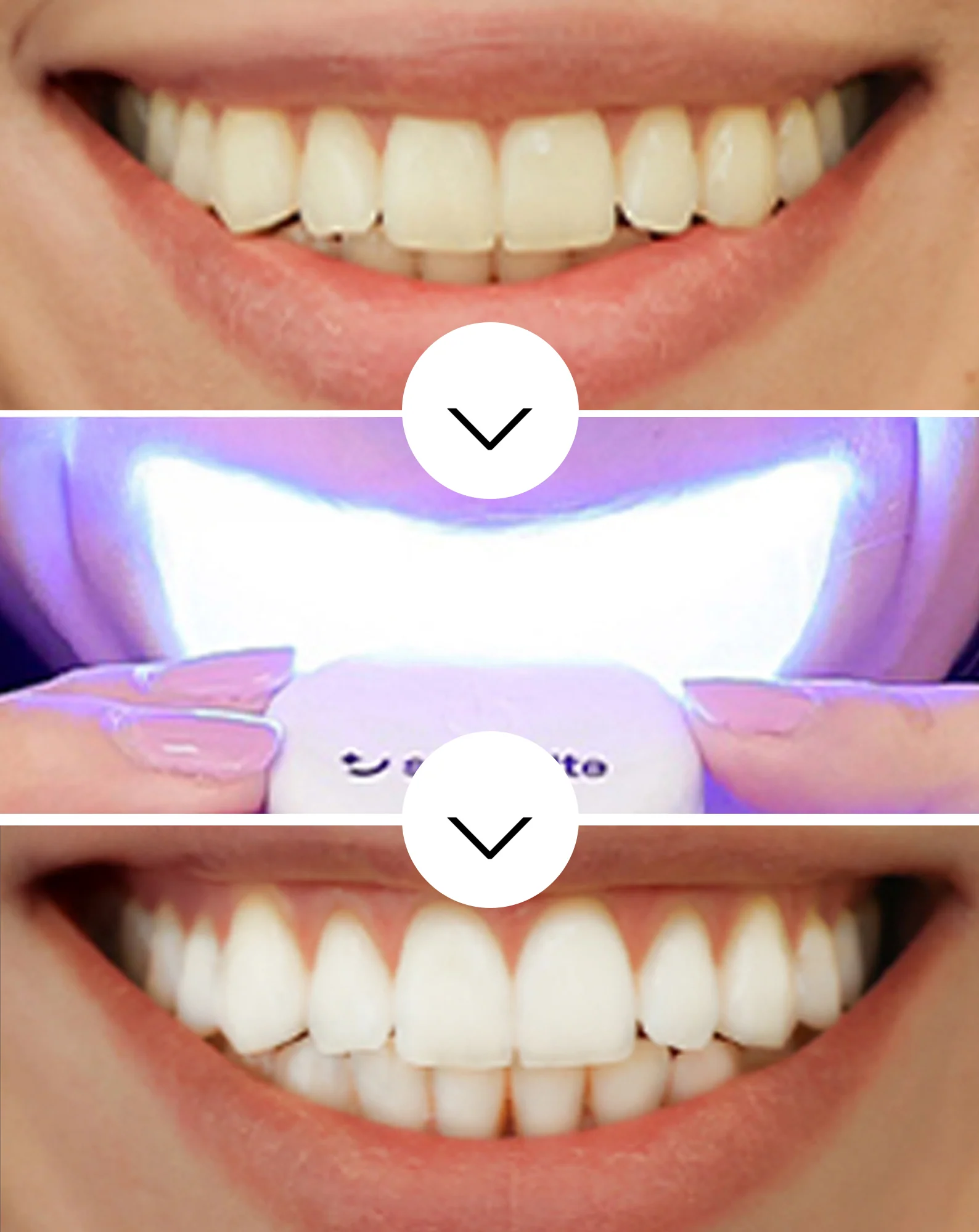 Smilebite Light & Bright LED Kit de blanchiment des dents + Whitesmile Serum™ - Image 3